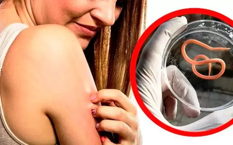 Picazón e irritación debido a parásitos en el cuerpo.